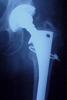example of an X-ray of a hip implant